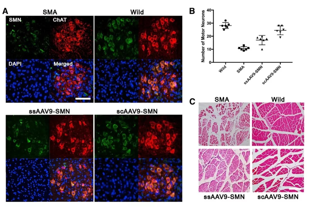 与时间赛跑，基于rAAV9载体胎儿基因治疗SMA新进展（一）
